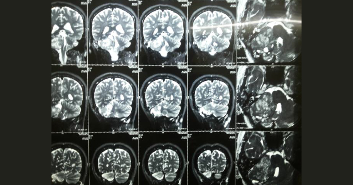 Management Of CP Angle Tumor