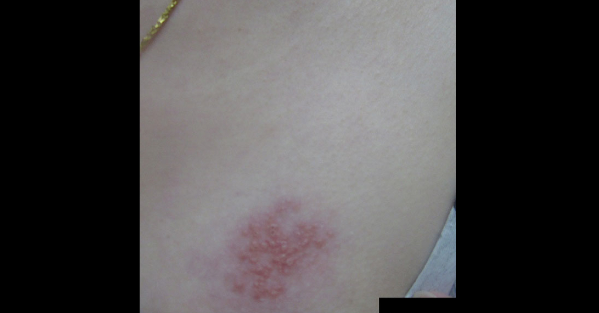 A Lady With Painful Vesicular Rash