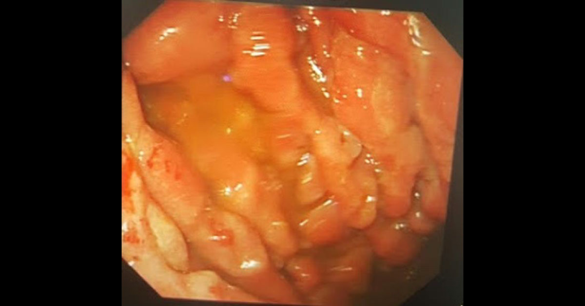 Case Of Fatigue In Male
