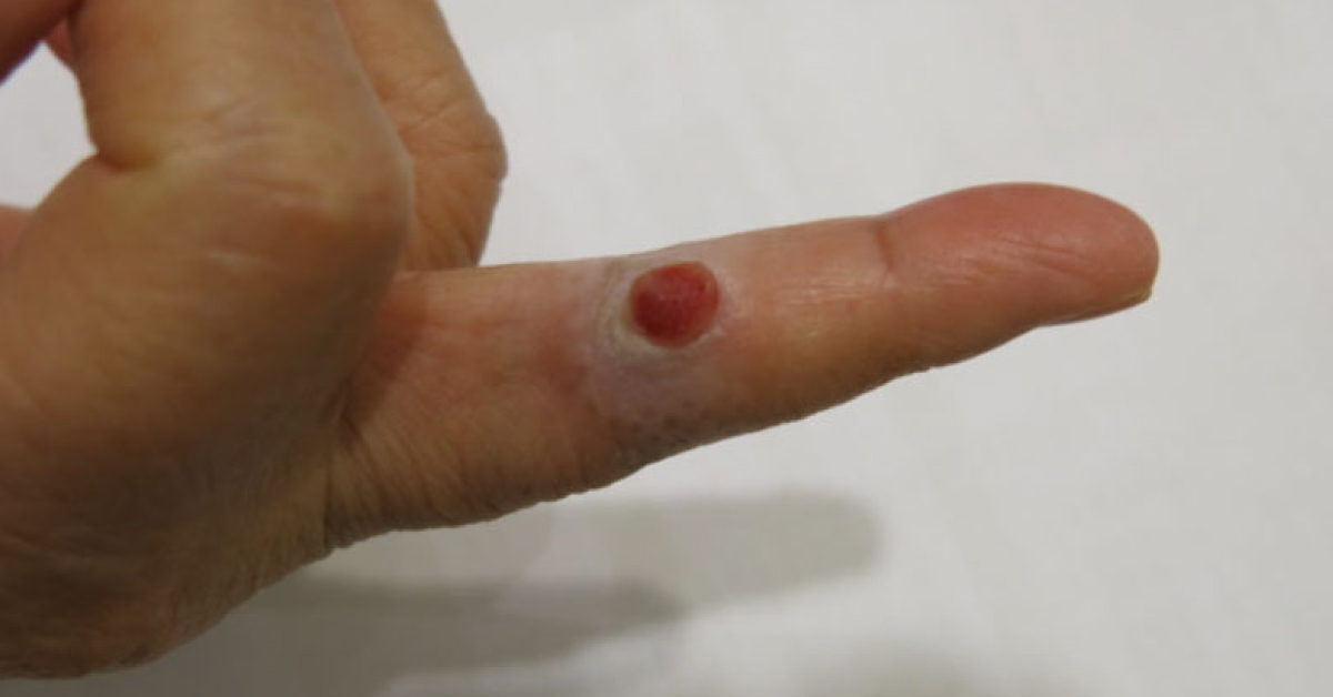 A Reddish Nodule Over Right Middle Finger