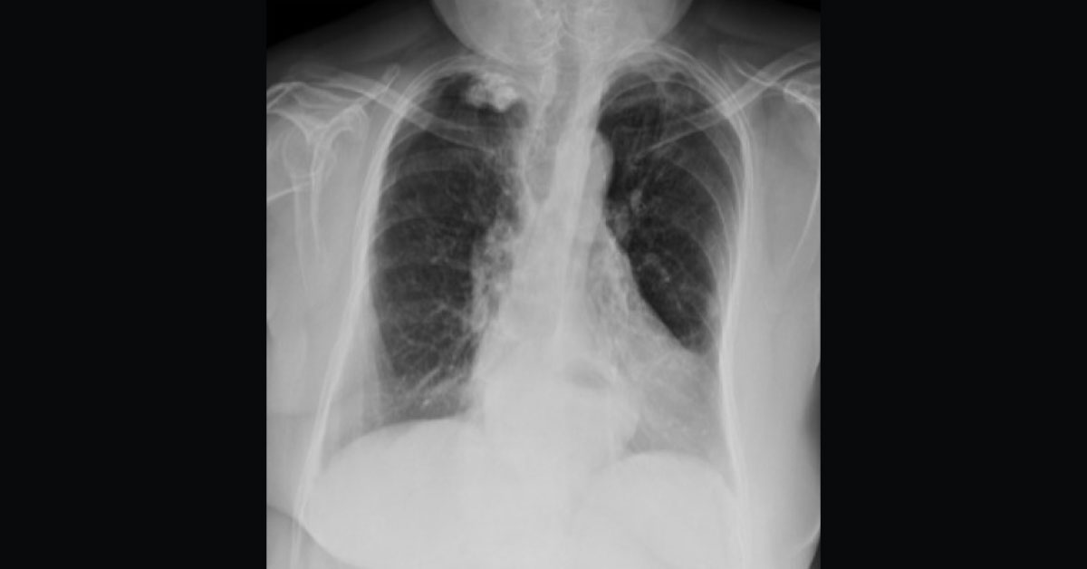 Diagnose From Radiograph Of Intermittent Heartburn