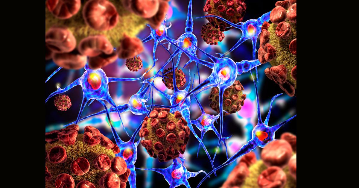 Overwhelming Research Confirmed Link Between Hepatitis And Parkinsonism