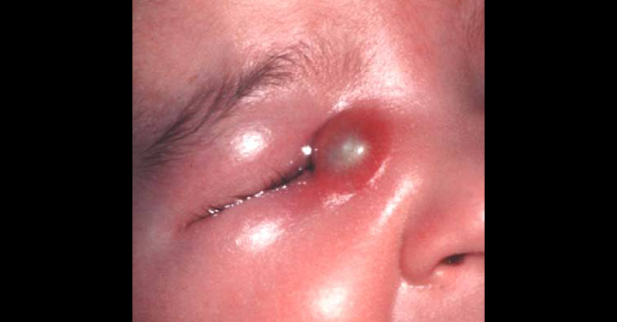 Spot This Ophthalmic Condition