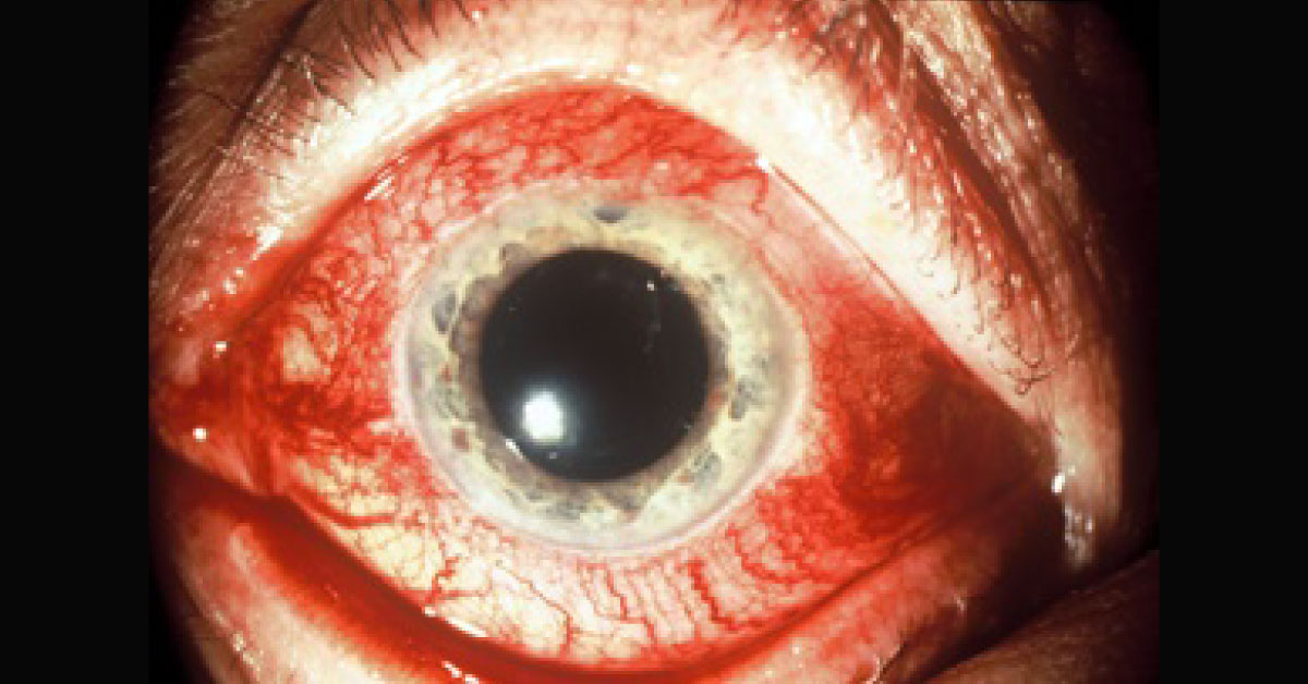 Spot The Ophthalmic Condition