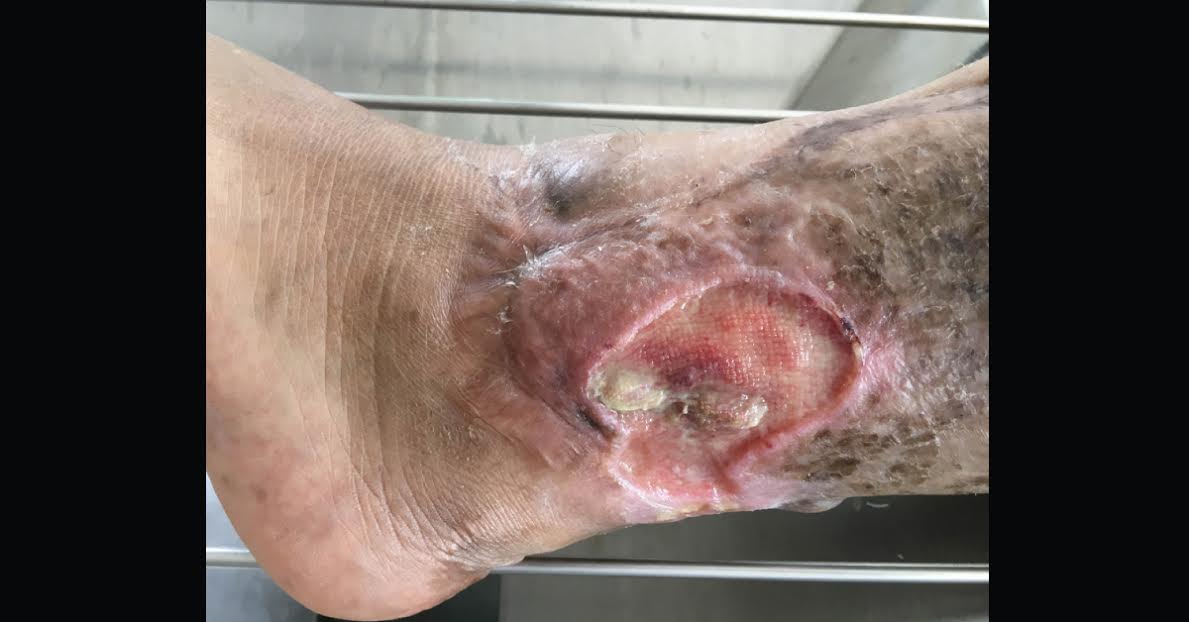 Management Of Venous Leg Ulcers