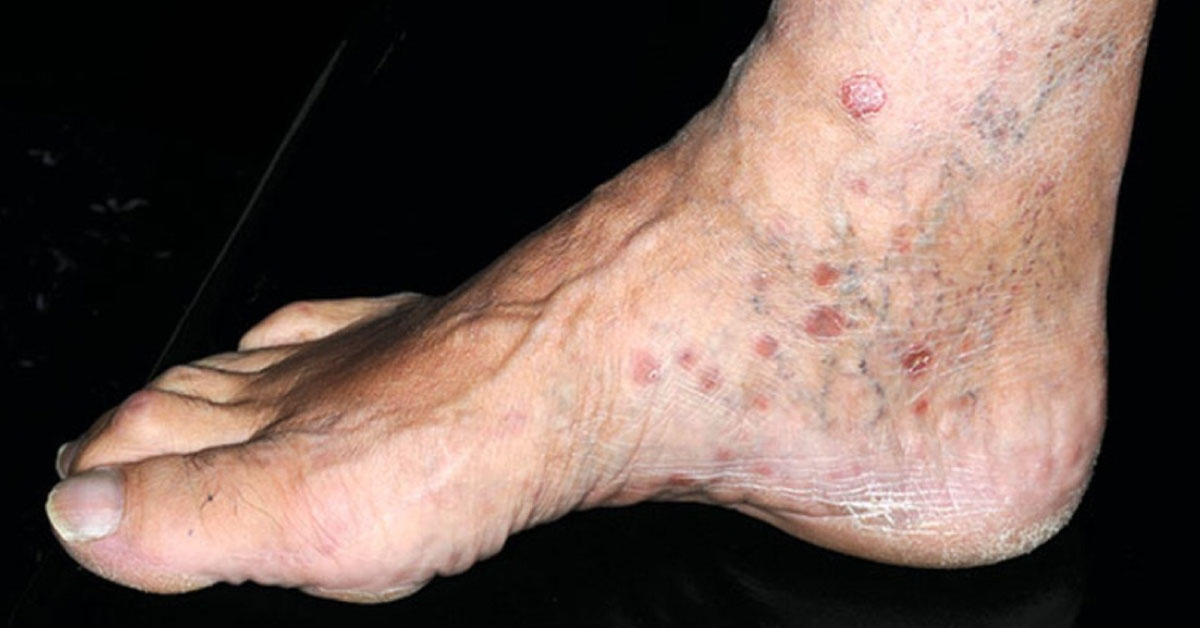 Identify The Cause Of Painless Sores