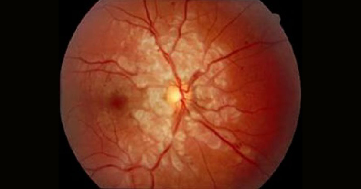 Spot The Ophthalmic Condition