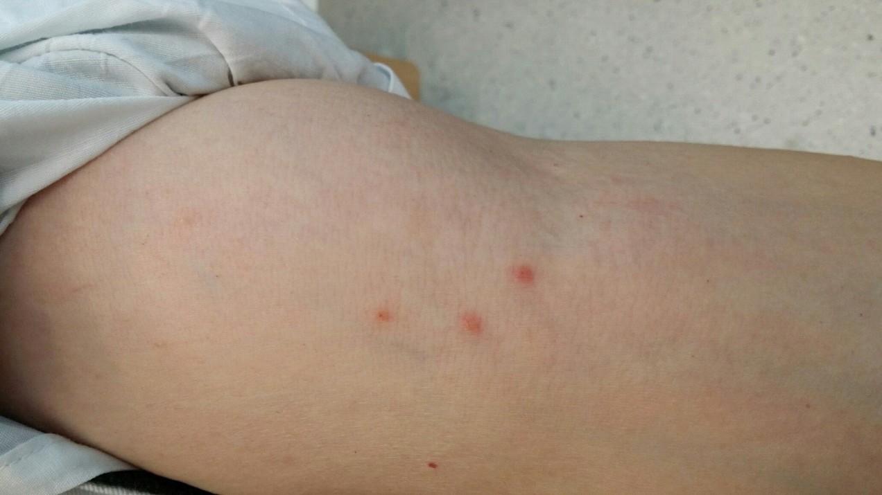 Itchy red spots on limbs