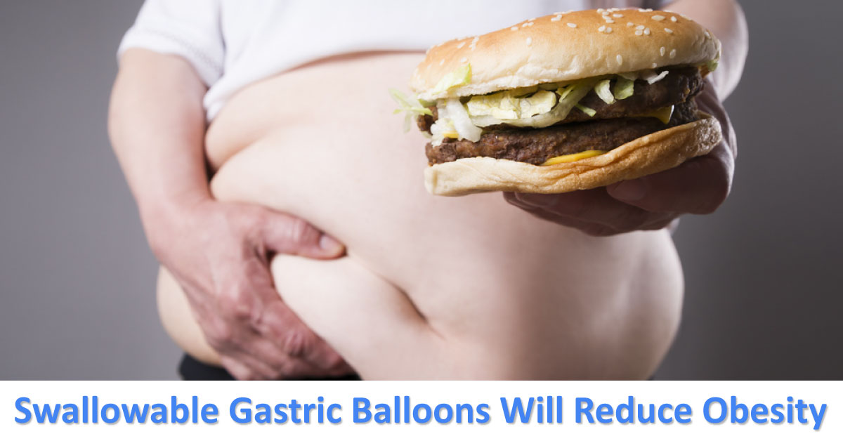 Swallowable Gastric Balloons Will Reduce Obesity
