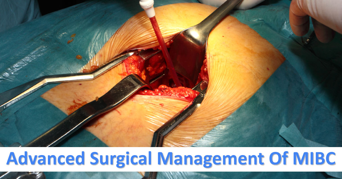 Muscle Invasive Bladder Cancer, Surgical Advances