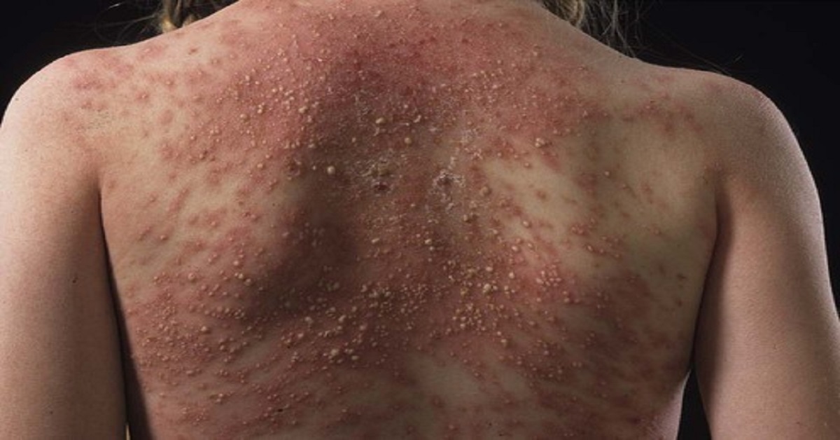 Acute Generalized Exanthematous Pustulosis, An Overview