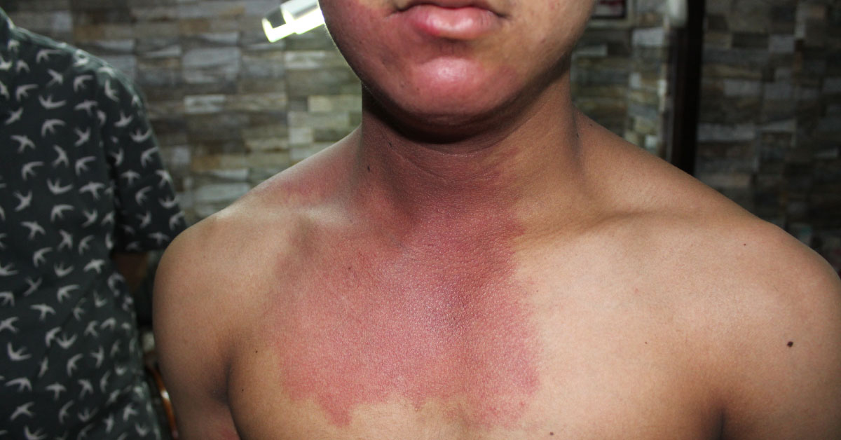 Suggest Treatment For PWS