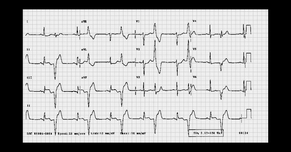 Identify Abnormality from ECG