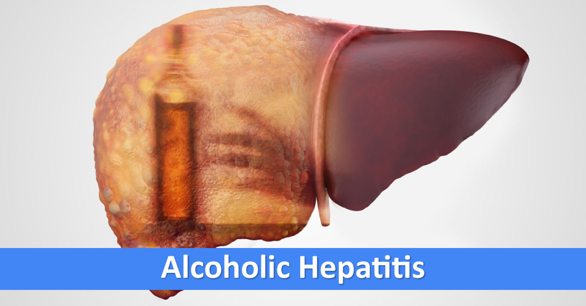 Management Of Alcoholic Hepatitis