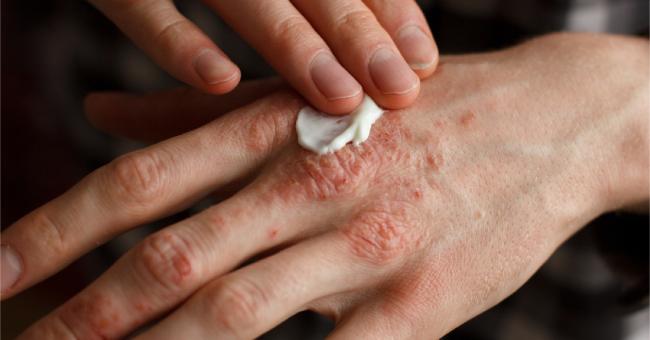 Azathioprine Use: British Association of Dermatologists (2011)
