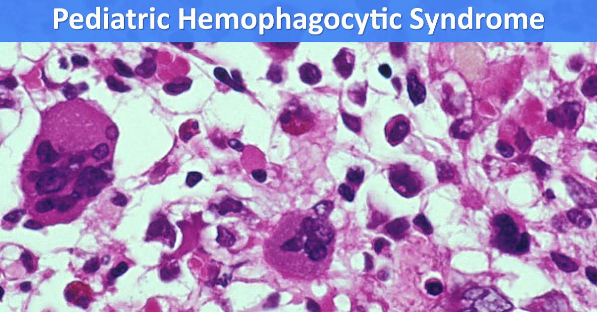 Pediatric Hemophagocytic Syndrome, An Insight