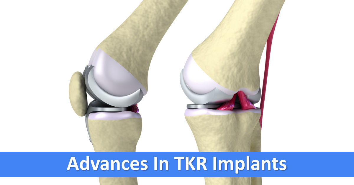 Total Knee Replacement Implants, Advancements For Better Choices