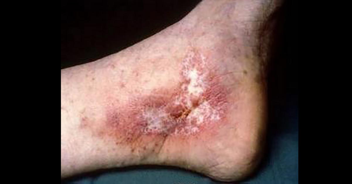 Identify the Dermal Lesion