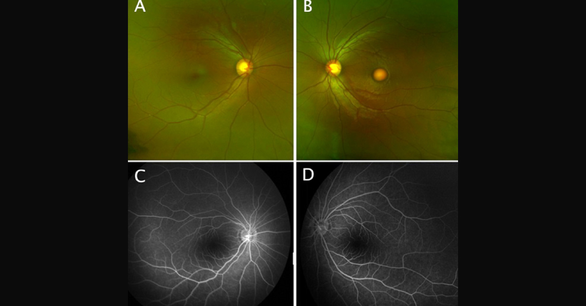 A Decreased Vision In A 5-Year-Old