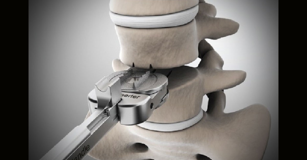 Prosthetic Intervertebral Disc Replacement