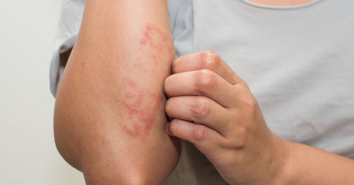 Psoriasis Management: National Institute for Health and Clinical Excellence