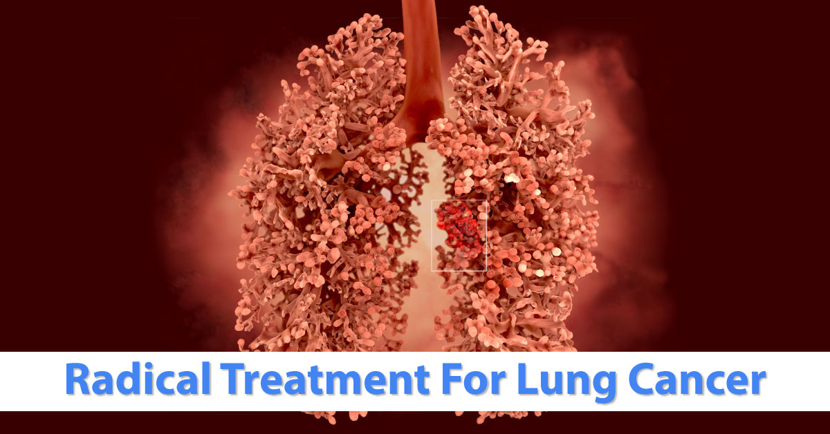 Lung Cancer Management with radical treatment