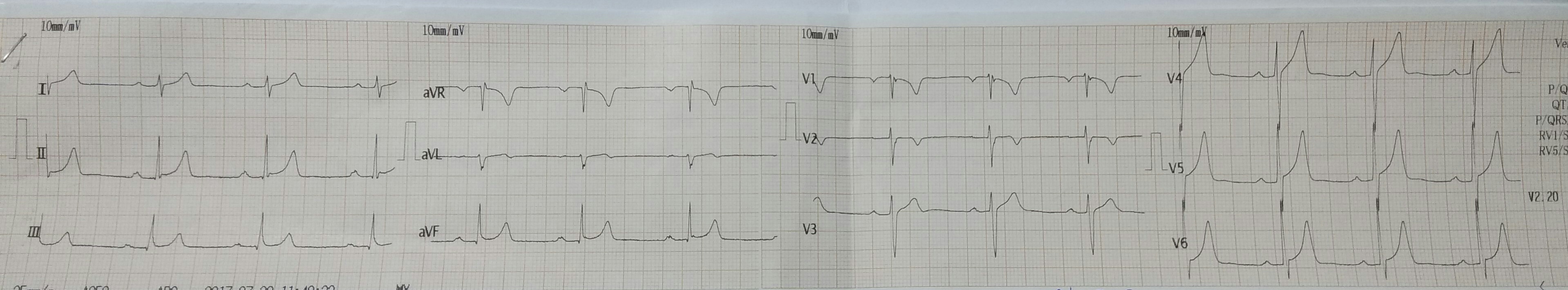 Interprete The ECG
