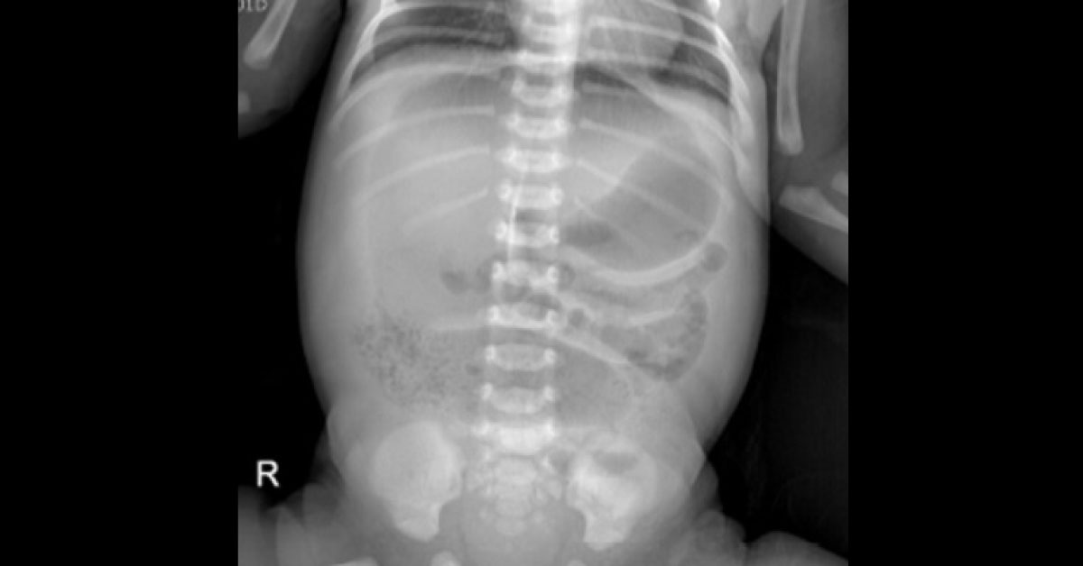 Neonatal Radiograph For Abdominal Distension