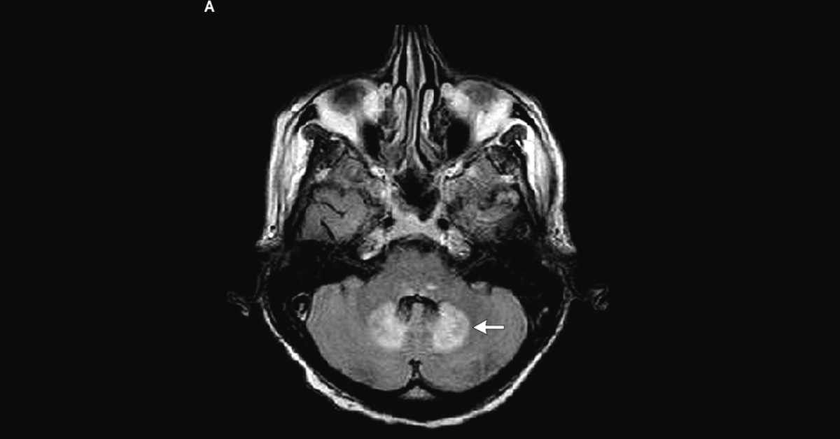 A Patient With Gait Instability