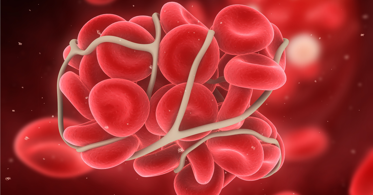 DVT, Confirmed Diagnosis Is Must For Long Term Follow Up