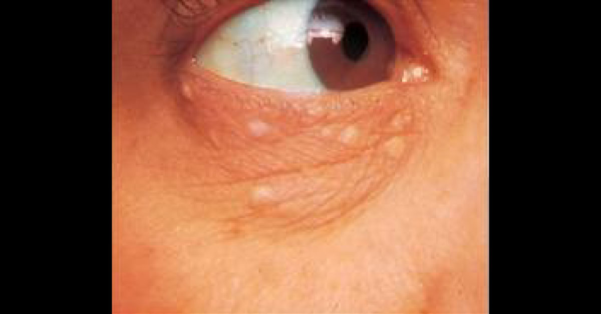 Identify The Dermal Condition