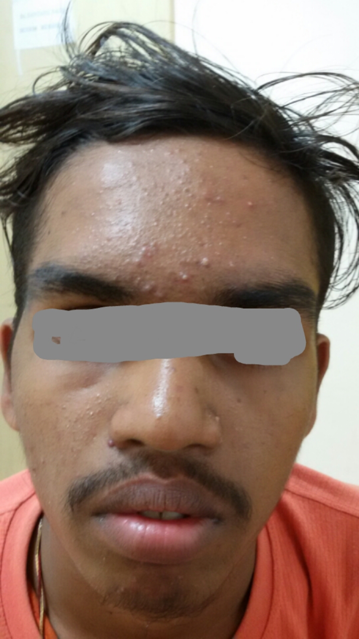 Lithium Carbonate And Skin Rash