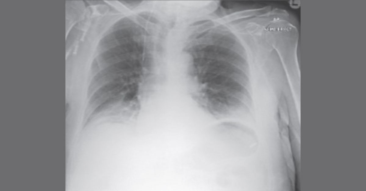 Case Of A Postoperative Pyrexia