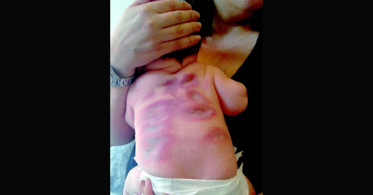 Pink plaques In An Infant