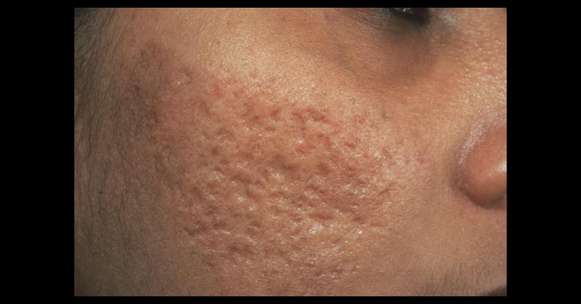 Treatment Options For Acne Scars