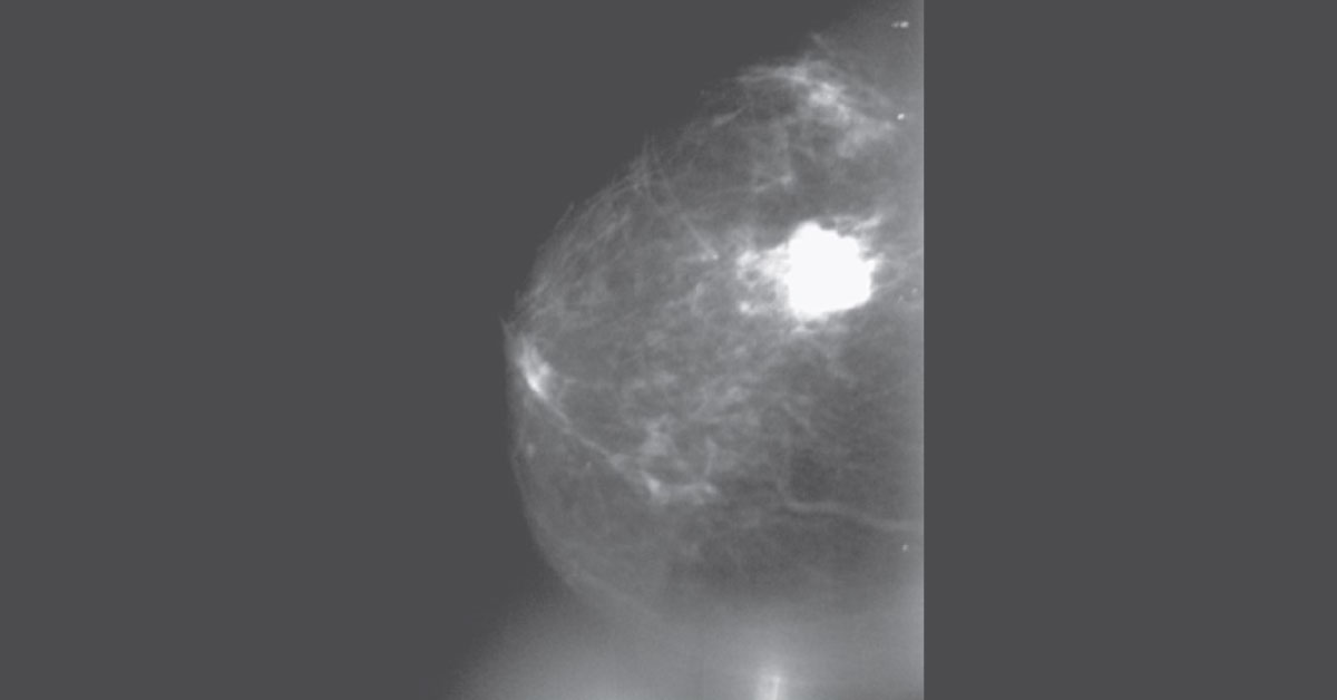 Assessment Of A Breast Lump