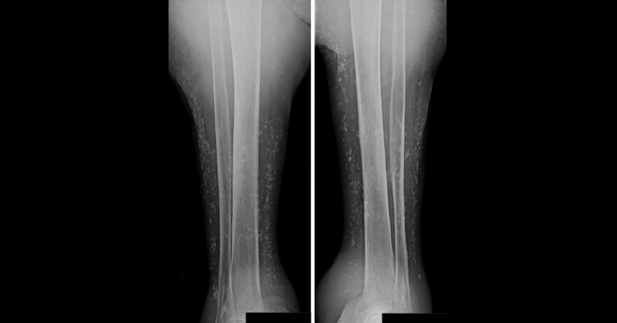 Identify This Condition From The Attached Radiograph