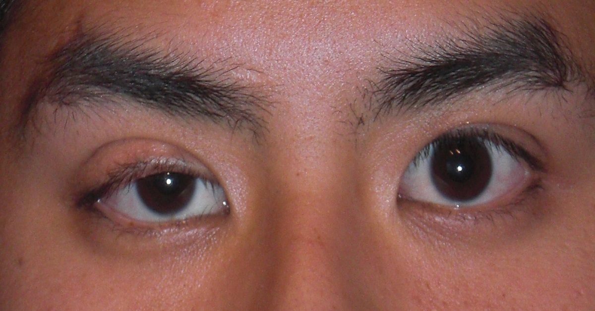 Resolve This Case Of Oculomotor Nerve Palsy