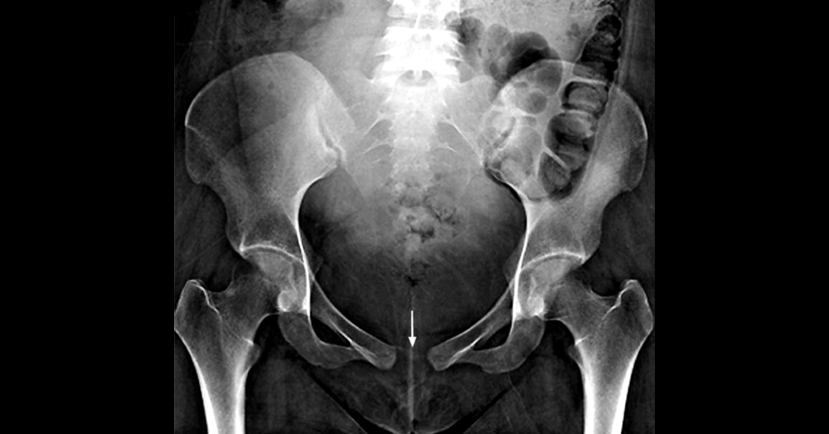 Identify The Condition From The Pelvic Radiograph