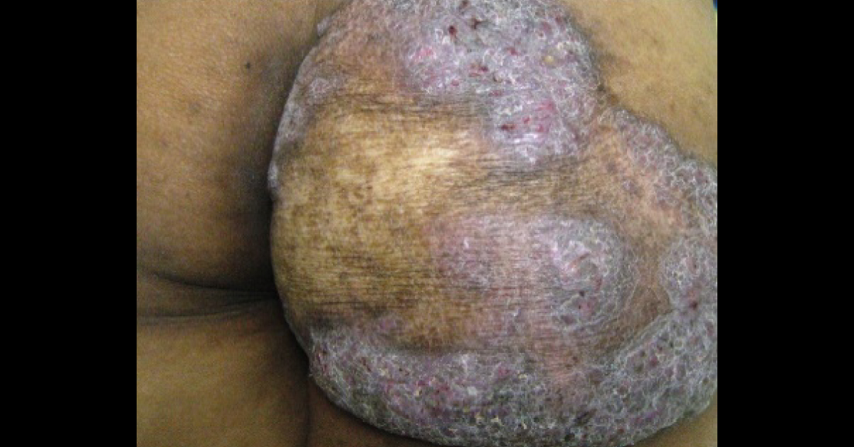 Diagnosis Of Infection On Right Buttock