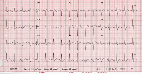 Spot The ECG