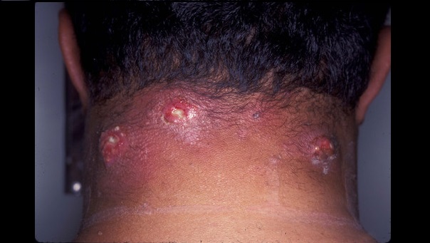 Identify the Dermal Condition