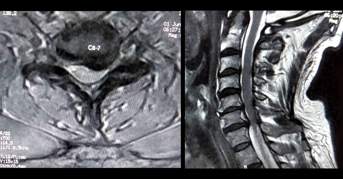 Diagnose The Postural Numbness And Painful Upper Limb