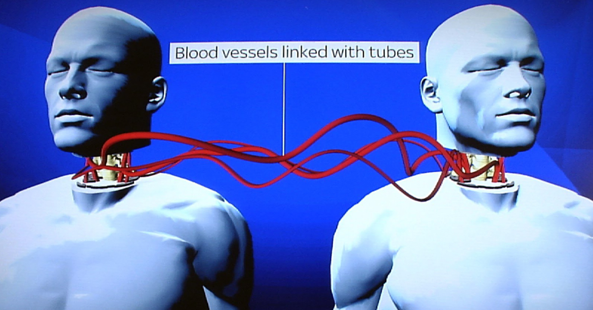 Head Transplant Team Reports Success In Rats