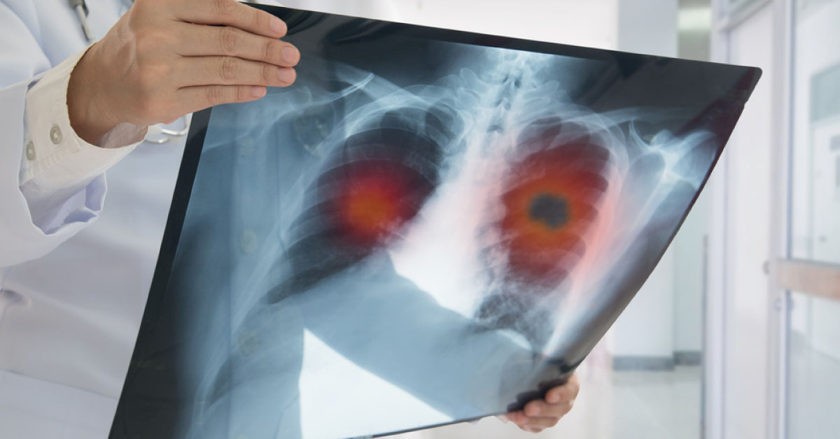 Lung Carcinoma Among Women