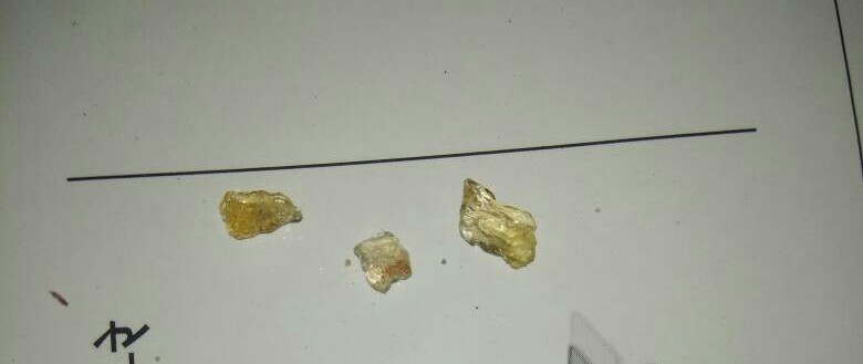 An Extremely Rare Case Of Primary Vaginal Stones