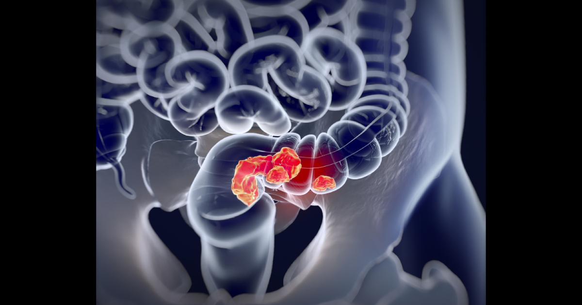 Laparoscopic versus open approach for Rectal cancer
