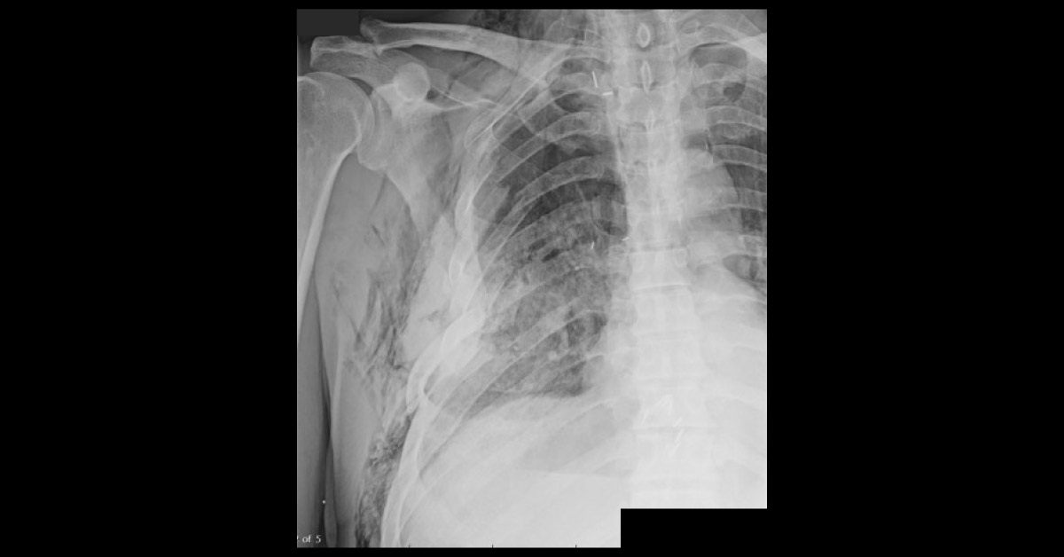 Identify The Condition From Radiograph