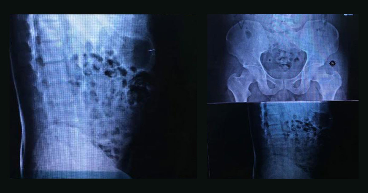 Chronic Pain Management In Lower Back