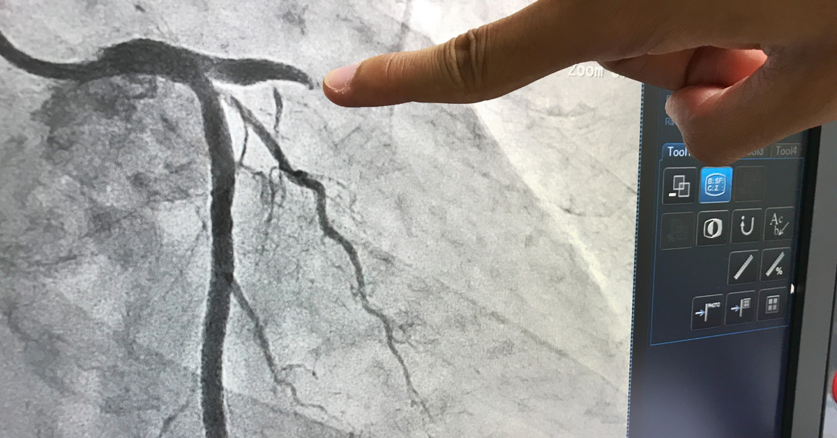 Coronary Angiography (CAG)- Essentials
